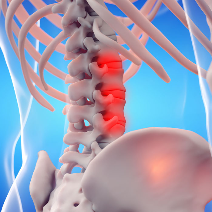 ankylosing spondylitis chiropractor in Newport Beach CA
