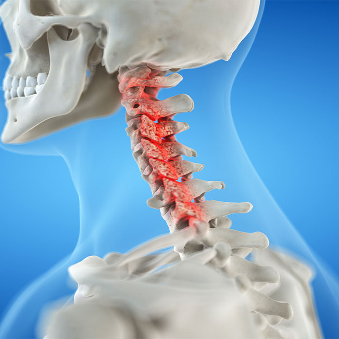 bone spur treatment in Newport Beach CA