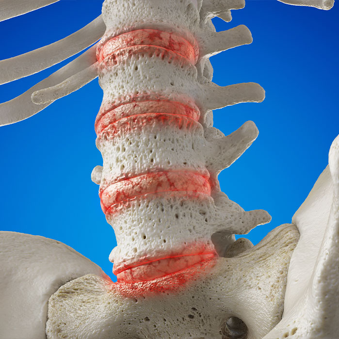 degenerative disc disease treatment in Newport Beach CA