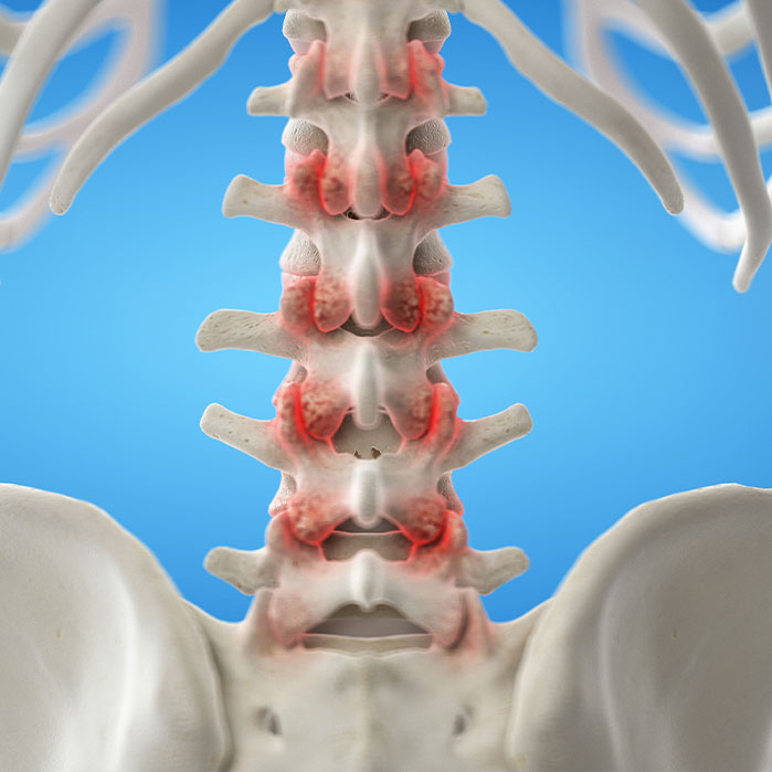 facet joint syndrome treatment in Newport Beach CA