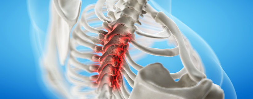 patient needing spinal stenosis treatment in Newport Beach