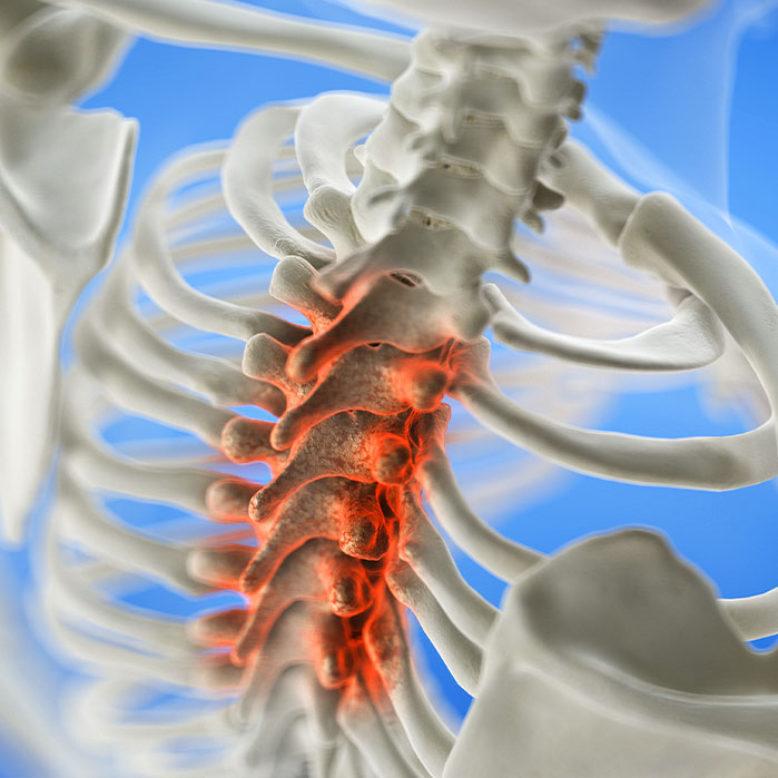 spinal stenosis treatment in Newport Beach CA
