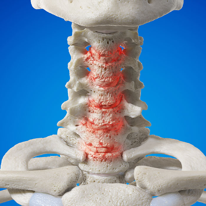 spondylosis treatment in Newport Beach CA
